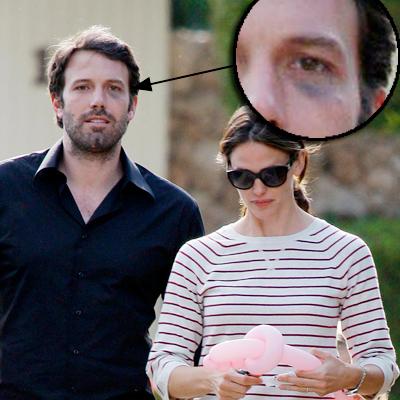 Photos Ben Affleck Sports Black Eye In L A