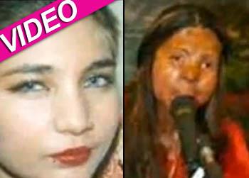 //acid attack victim pakistan suicide