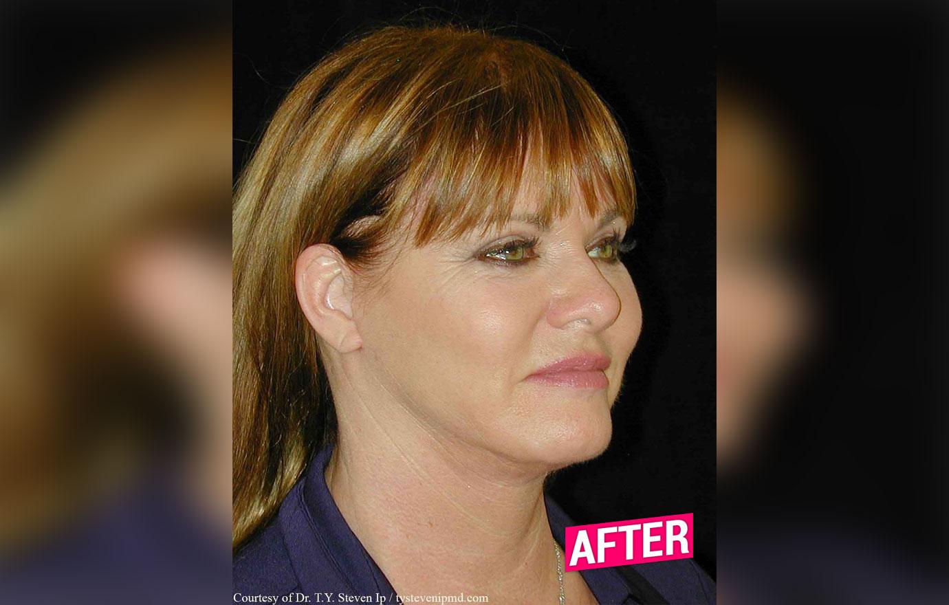 //rhoc Jeana Keough plastic surgery makeover