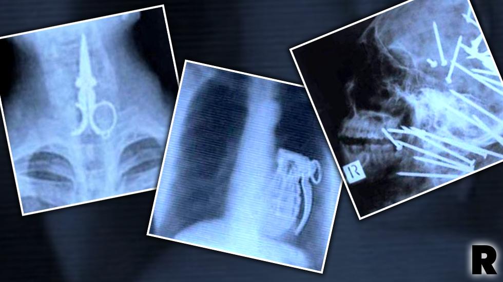 Inside Story Weird Objects And Horrifying Injuries Caught On X Ray 