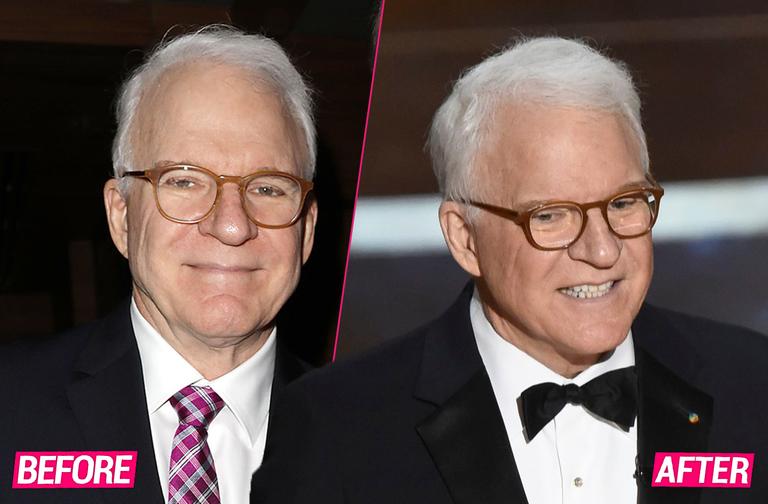 Plastic Surgeons Reveal Steve Martin's Secrets To Youthful Look