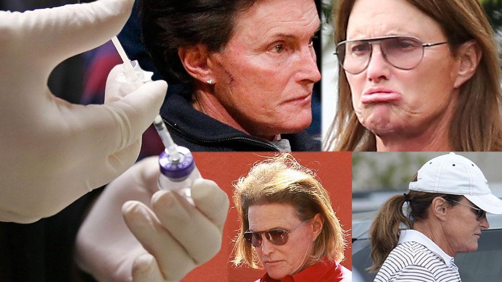 //bruce jenner sex change spent  transition hair botox fillers