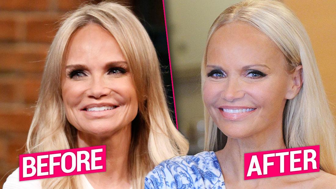 Kristin Chenoweth Plastic Surgery Makeover Exposed By Top Docs