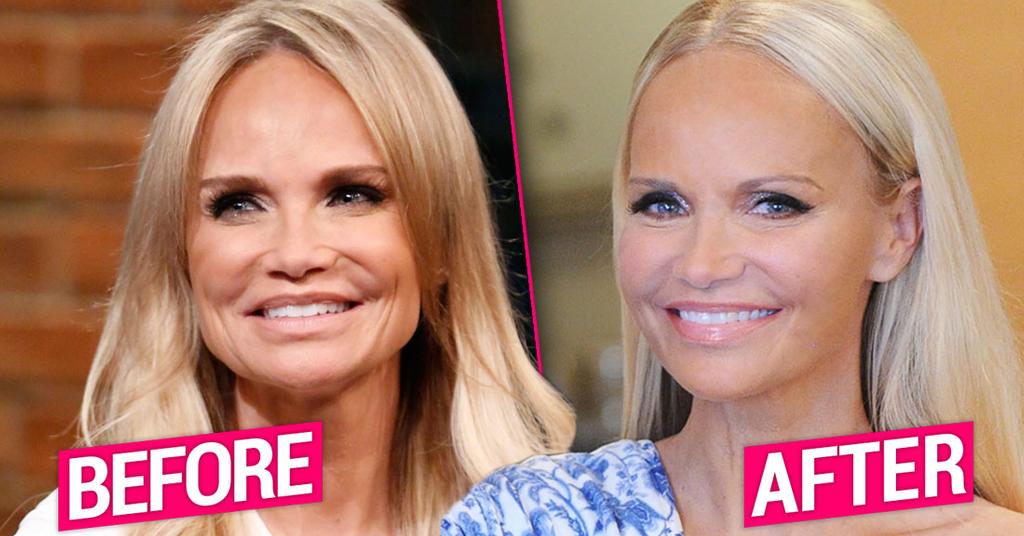 Kristin Chenoweth Plastic Surgery Makeover Exposed By Top Docs