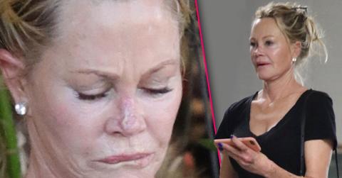Melanie Griffith Sports Nose Scar After Skin Cancer