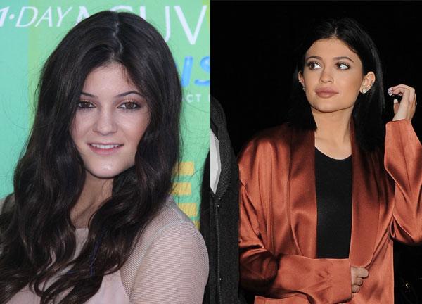 //kylie jenner plastic surgery top doctor estimates boob job face work extensions