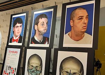 //gun accident face transplant ap