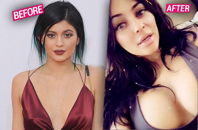 //Kylie Jenner Boob Job Breast Augmentation ppbIhd