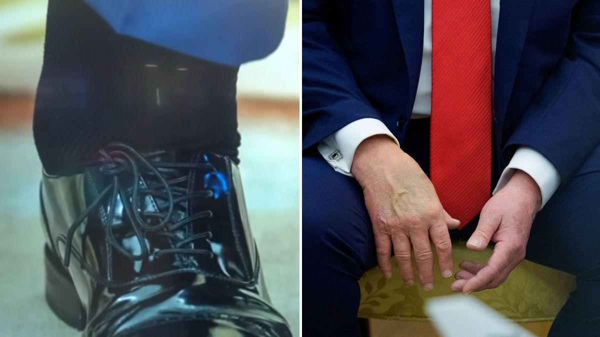 Split photos of Donald Trump's swollen ankles and bruised hands