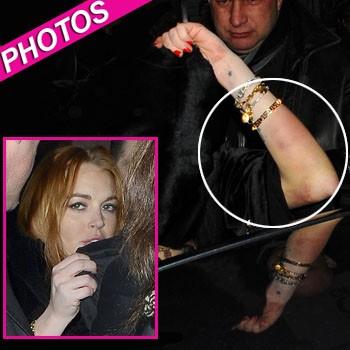 //lindsay lohan bruise london post