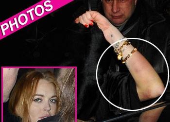 //lindsay lohan bruise london post
