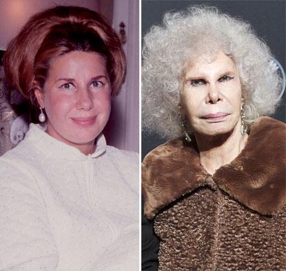 //duchess of alba plastic surgery before after