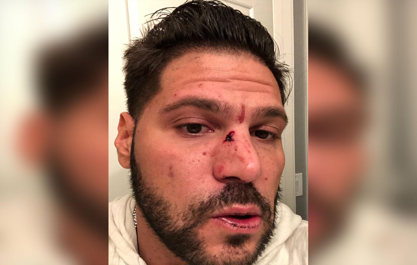 Ronnie Ortiz-Magro suffered a series of injuries after his New Year’s Eve fight with on-off girlfriend Jen Harley