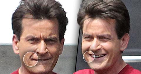 //charlie sheen hiv positive lesions face pp