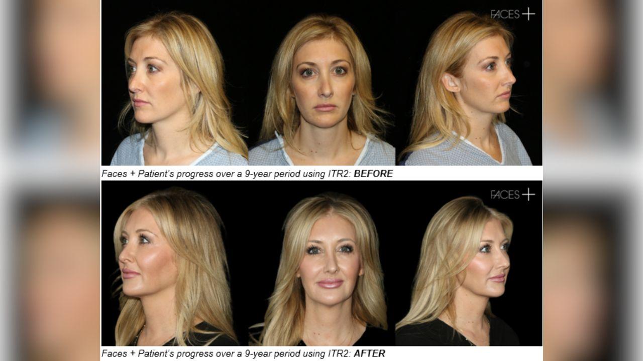 the ozempic face problem nobody warned you about and what surgeons are doing to fix it