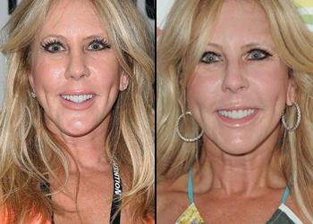 Goodbye Miss Piggy, Hello Miss Plastic Surgery! Vicki Gunvalson Undergoes Dramatic Surgical Makeover