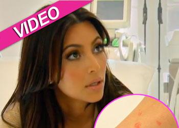 //kim kardashian rash