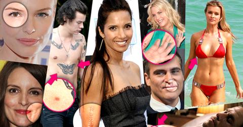 //celebrity physical deformities pp