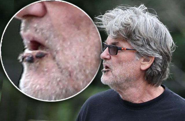 Kurt Russell Shows Lip Sores