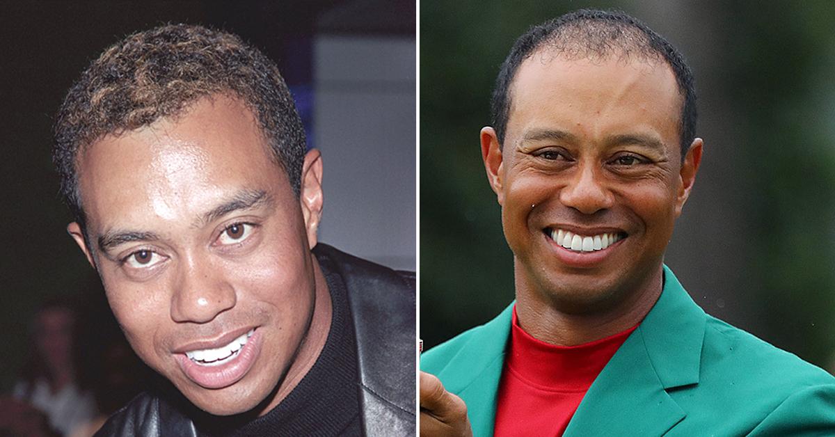 tiger woods hairline photos crash investigation