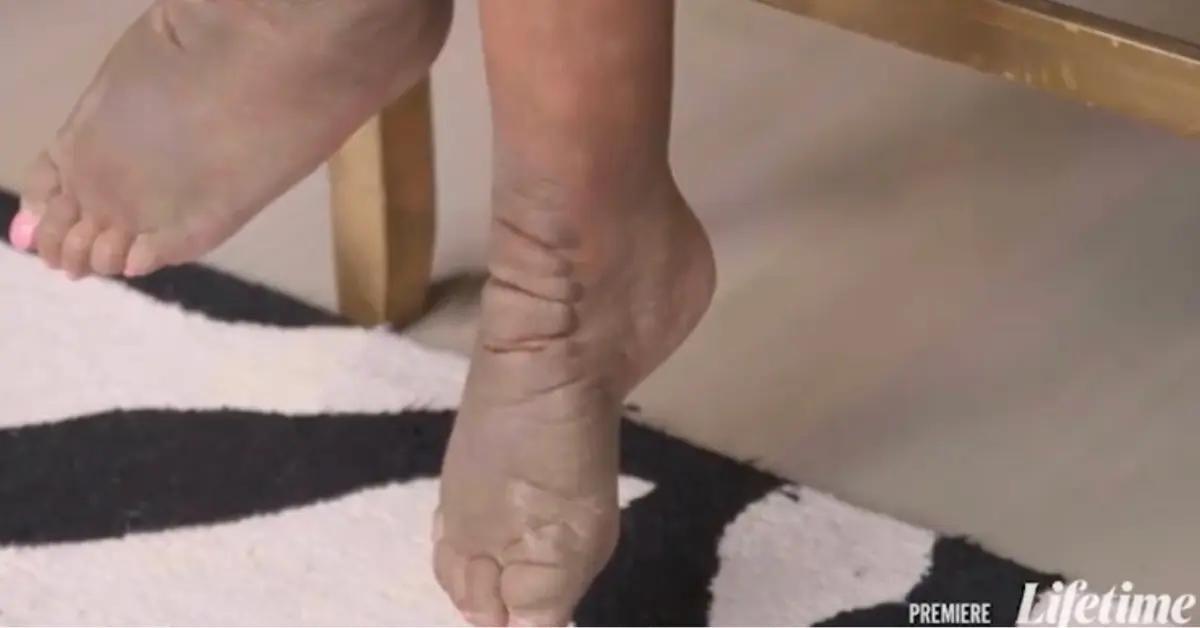 wendy williams deformed feet