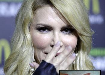 //pp_brandiglanville_burnedhand_wenn