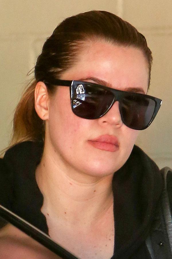 Kardashians Acne Rashes Photos