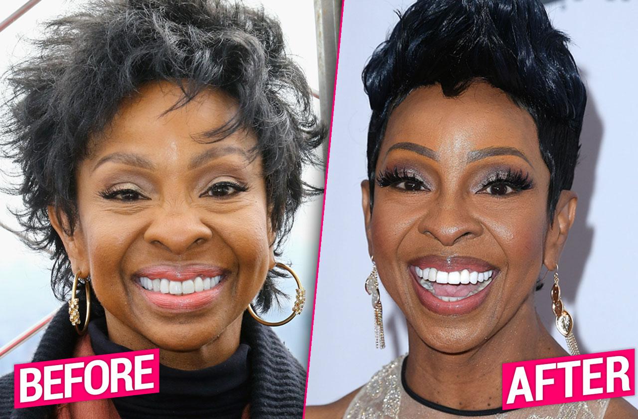 Gladys Knight Unrecognizable After Plastic Surgery