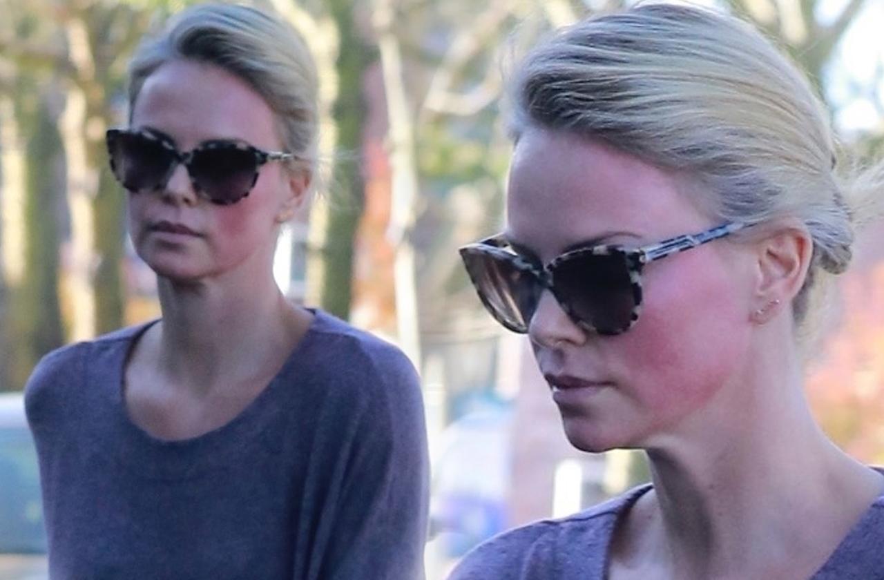 charlize theron face nasty welts facial procedure