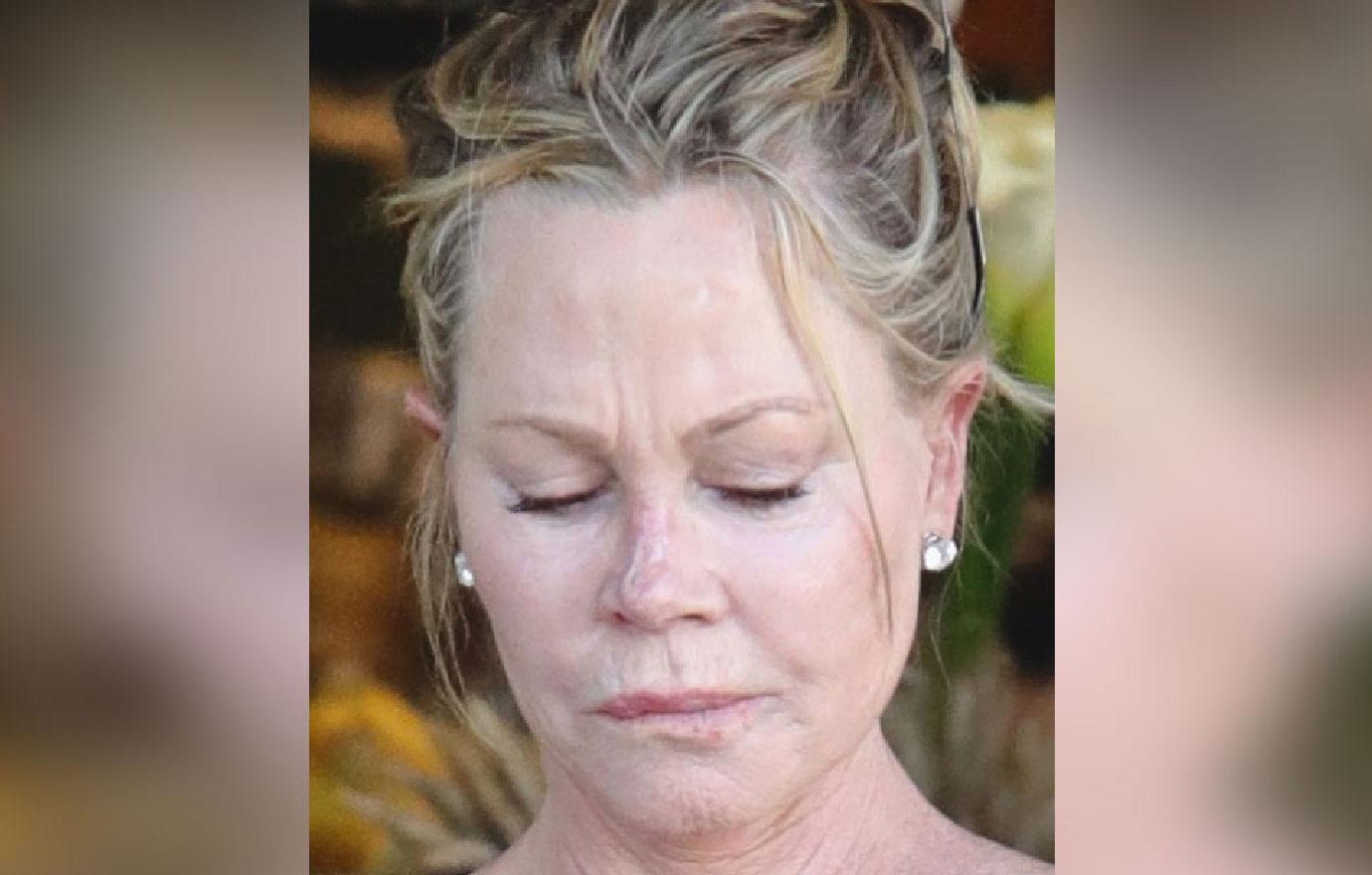 Melanie Griffith Sports Nose Scar After Skin Cancer