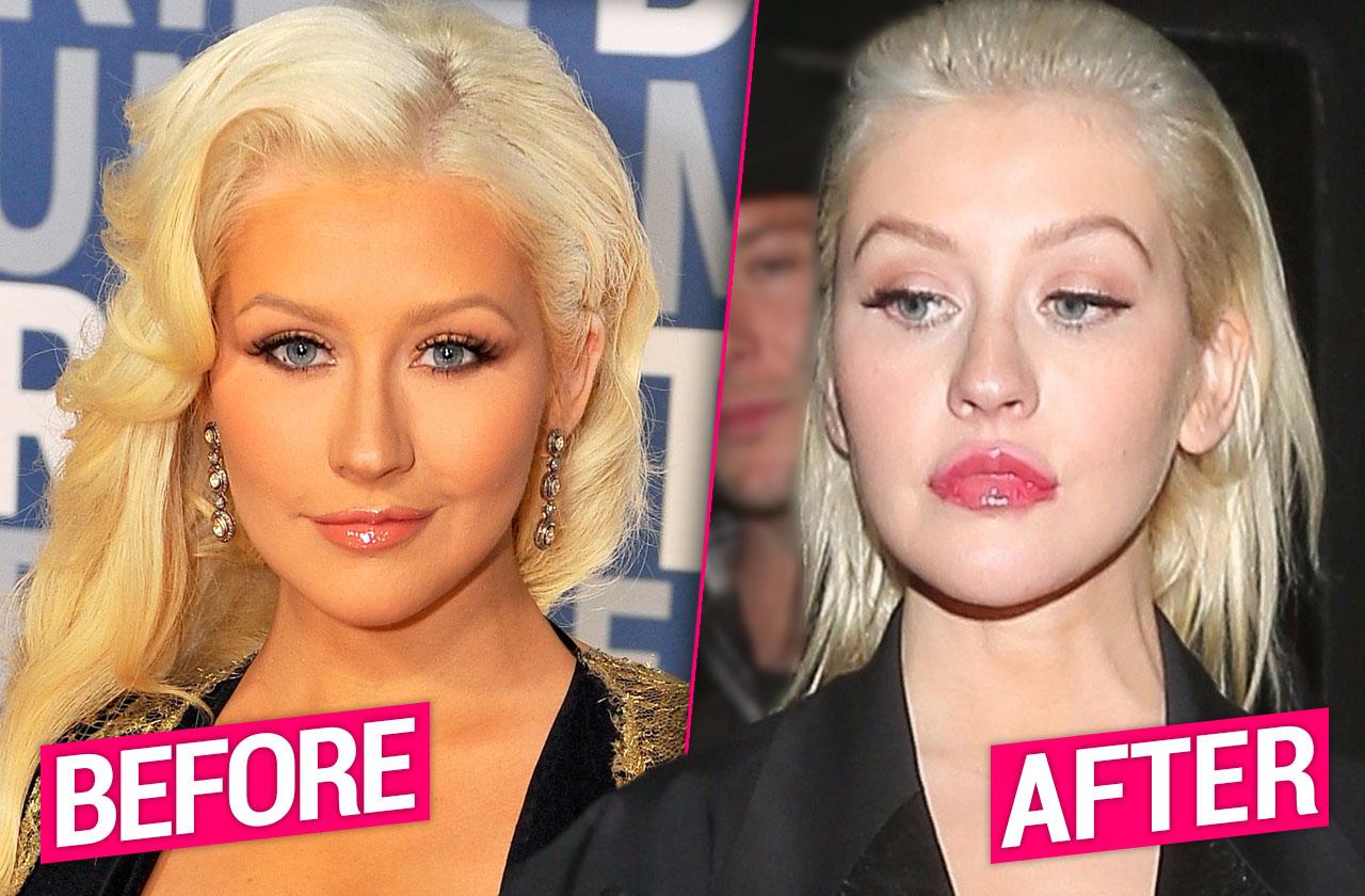 Christina Aguilera's 'Swollen' & 'OverPlumped' Lips Caused By Plastic