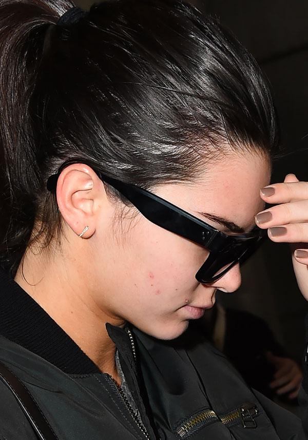 Kardashians Acne Rashes Photos