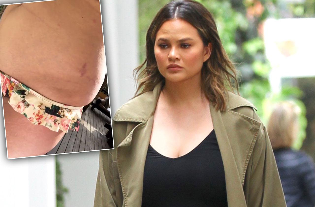 Chrissy Teigen Shows New Mom Bod Stretch Marks In Video 5765