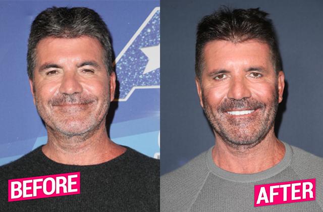 Simon Cowell Plastic Surgery Makeover Exposed By Top Docs