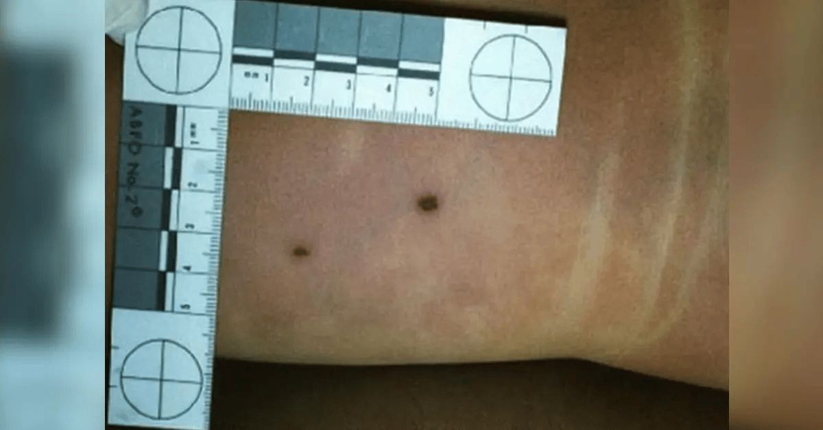 Photo of markings observed on JonBenét's body