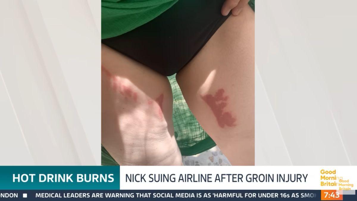 He shared photos of his injuries and burns.