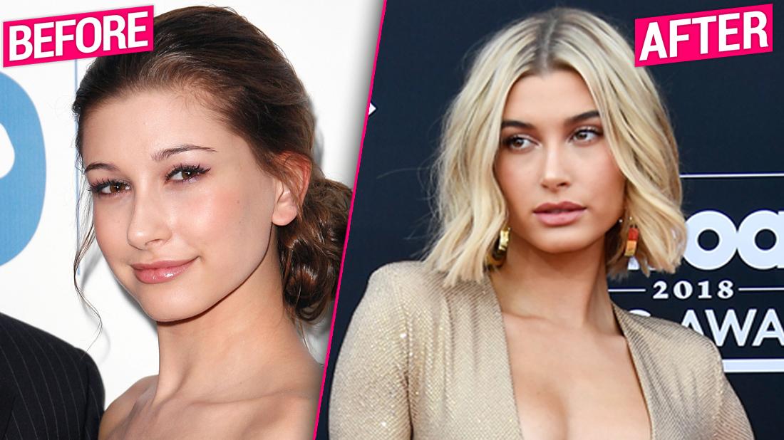 Hailey Baldwin's Plastic Face Exposed By Top Doctors.