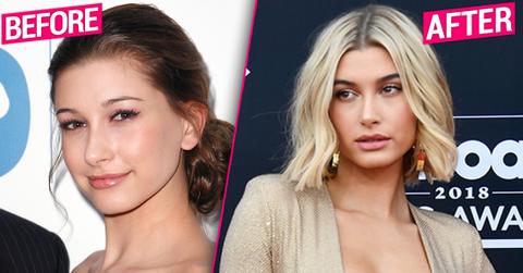 ‘Nose, Lips, Brows, Fillers' & More! Hailey Baldwin's Plastic Face Dissected By Top Docs