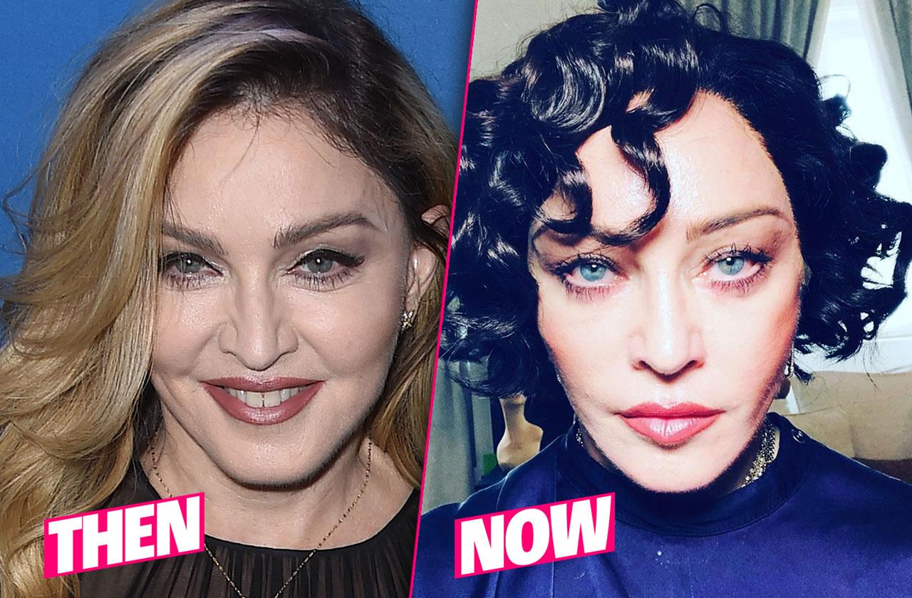 Madonna Before After Plastic Surgery Pp 