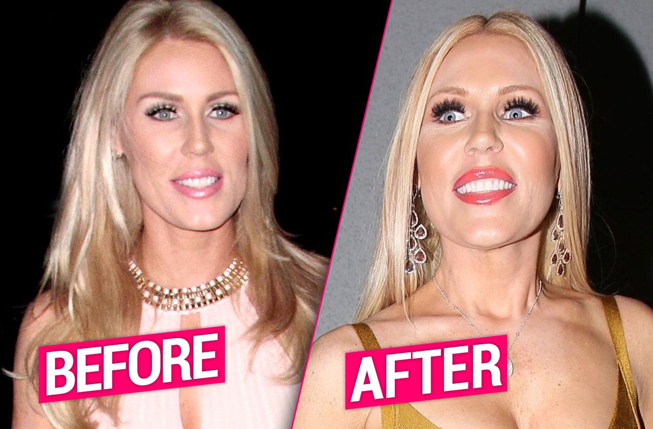 ‘rhoc Star Gretchen Rossi ‘extensive Plastic Surgery Procedures