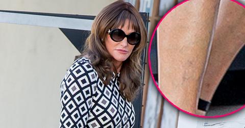 Caitlyn Jenner Plastic Surgery Legs Varicose Veins
