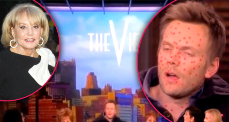 //joel mchale chicken pox view