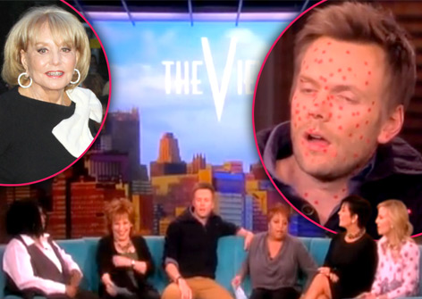 //joel mchale chicken pox view