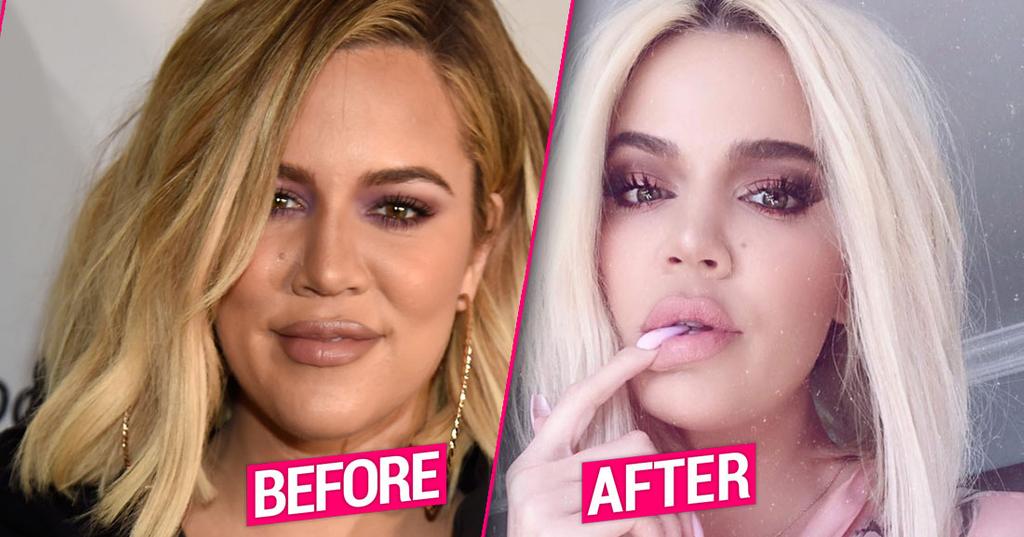 Khloe Kardashian’s Plastic Surgery Makeover After Split