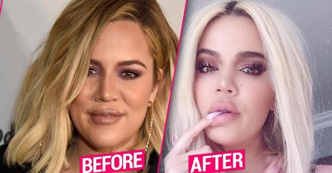 Khloe Kardashian Before After Tristan Thompson Plastic Surgery Face Photos