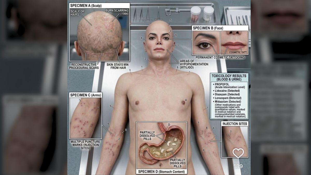 Photo of Michael Jackson autopsy
