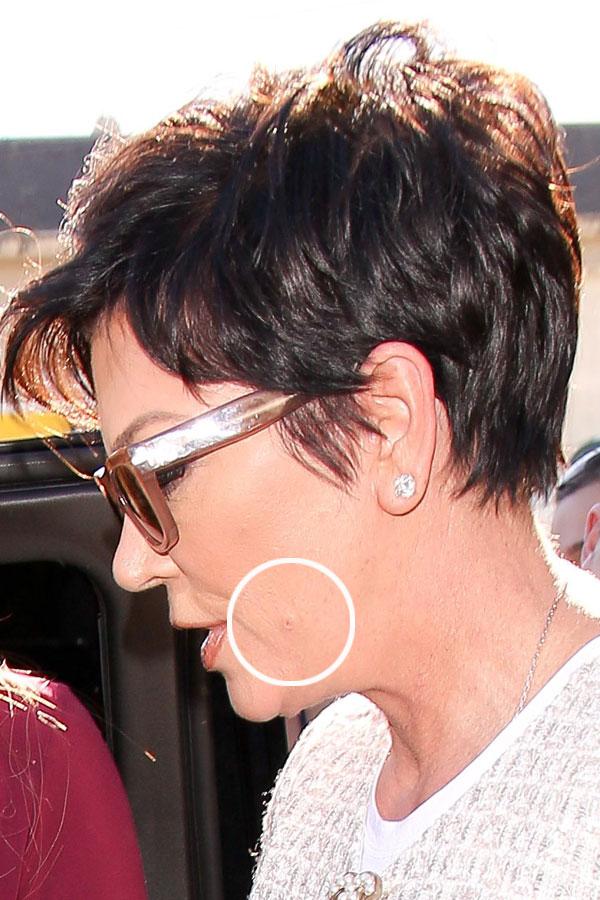 Kardashians Acne Rashes Photos