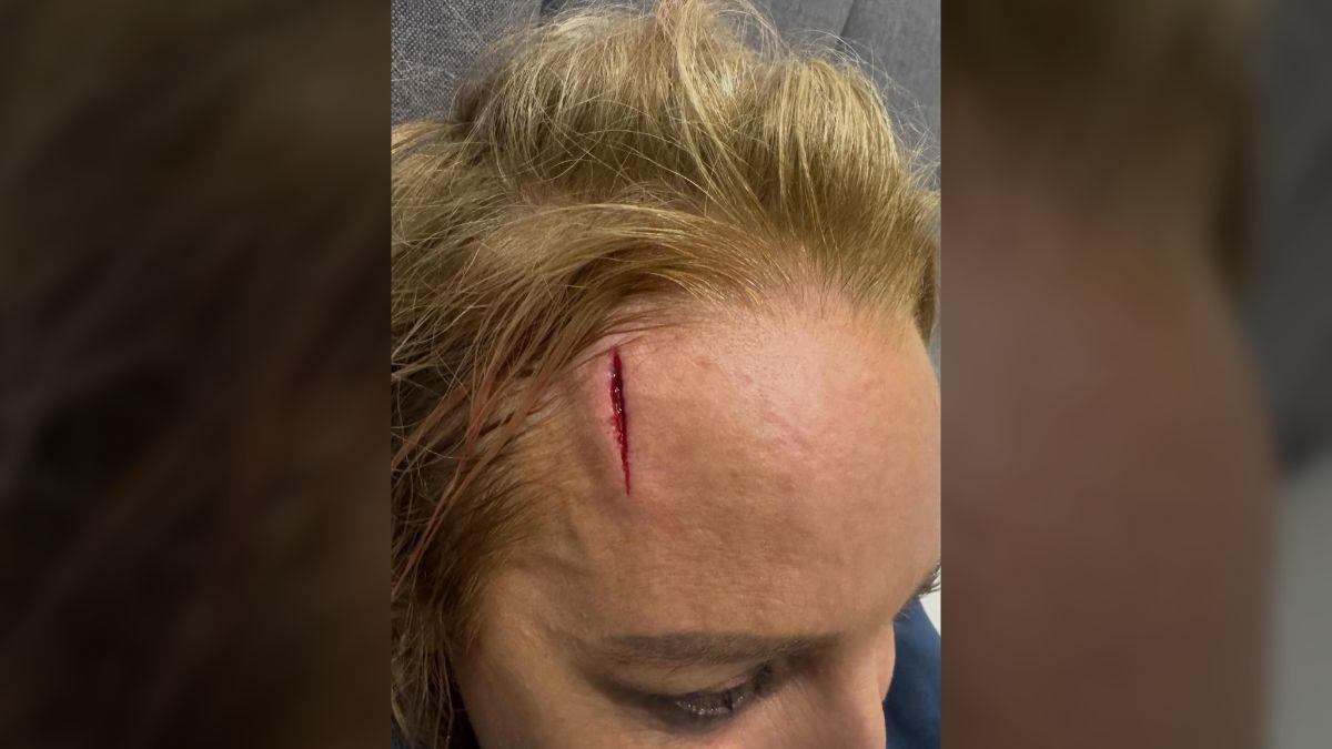 image of The TV host said the injury looked 'like a crime scene' after she hit a wall in the dark.