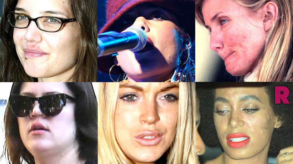 Nobody’s Perfect! Kim’s Psoriasis, Brit’s Zits & Lindsay’s Cold Sores