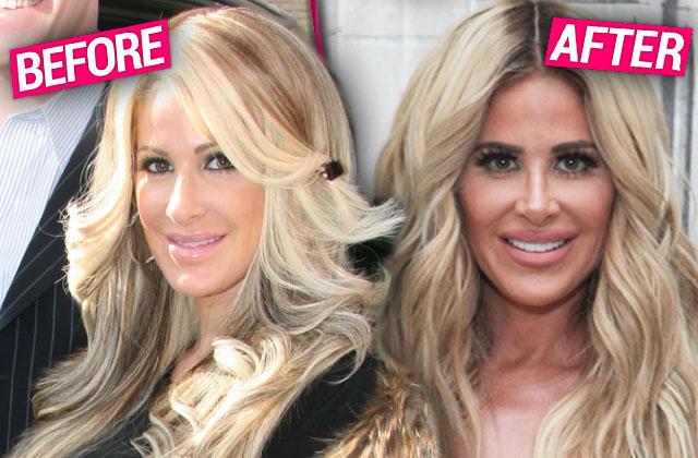 Kim Zolciak Biermann Plastic Surgery Claims Exposed By Top Docs